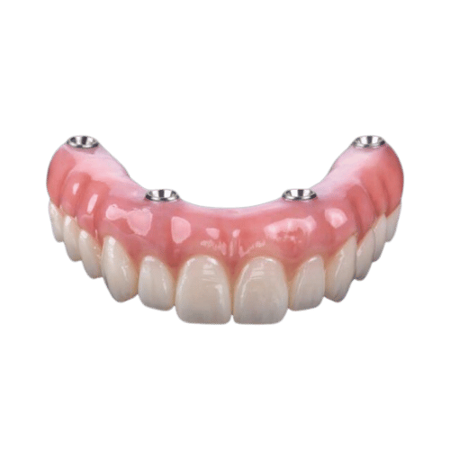 All-on-X (All-on-4) Dental Implants - toofus™ Dental