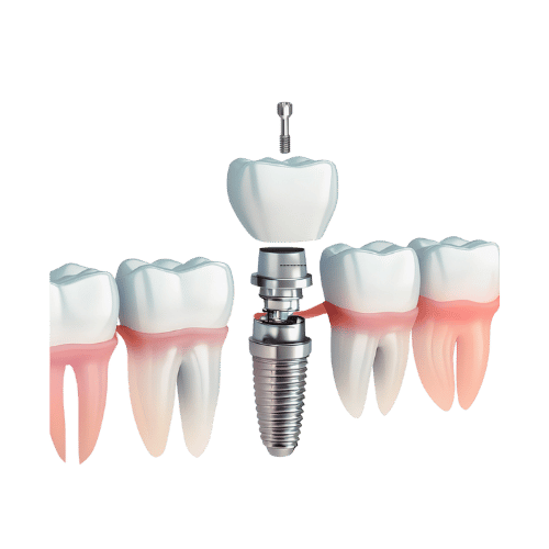 Dental Implants - toofus™ Dental