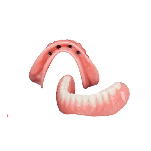 Overdentures (Dentures Over Implants) - Dentures - toofus™ Dental