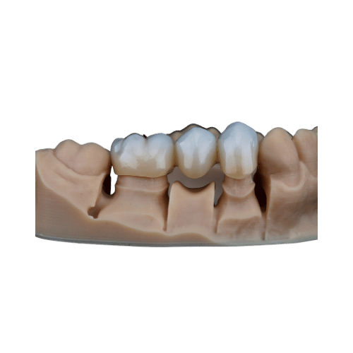 Dental Bridge - toofus™ Dental