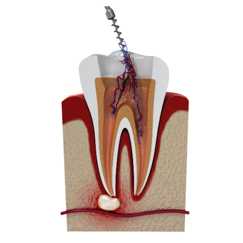 Root Canal Treatment - toofus™ Dental