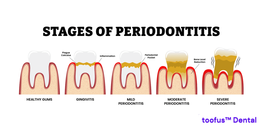 Stages of gum disease from gingivitis to periodontitis – toofus™ Dental
