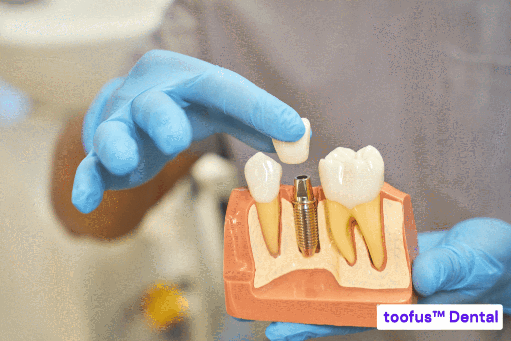 The Essential Guide: Stop Hidden Costs for Dental Implants 2 Dentist holding a dental model of a dental implant - toofus™ Dental